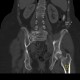 Stress fracture of sacrum: CT - Computed tomography